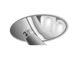 Насадка BS2L для Satelec (Acteon) Piezotome CUBE/Solo (LED) 2/Piezotome 2/Implant Center 2 f87502 f87613 3