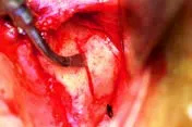 Насадка BS5 для Satelec (Acteon) Piezotome CUBE/Solo (LED) 2/Piezotome 2/Implant Center 2 f87505 f87616 3