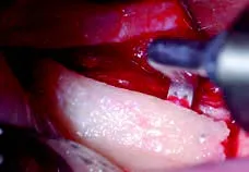 Набор насадок Satelec (Acteon) BS Kit (Bone Surgery - BS1S, BS2L, BS2R, BS4, BS5, BS6) для Piezotome CUBE/Solo (LED) 2/Piezotome 2/Implant Center 2 f87509 11