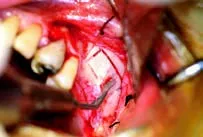 Набор насадок Satelec (Acteon) BS Kit (Bone Surgery - BS1S, BS2L, BS2R, BS4, BS5, BS6) для Piezotome CUBE/Solo (LED) 2/Piezotome 2/Implant Center 2 f87509 15