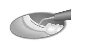 Набор насадок Satelec (Acteon) BS Kit (Bone Surgery - BS1S, BS2L, BS2R, BS4, BS5, BS6) для Piezotome CUBE/Solo (LED) 2/Piezotome 2/Implant Center 2 f87509 18