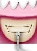 Набор насадок Satelec (Acteon) BS Kit (Bone Surgery - BS1S, BS2L, BS2R, BS4, BS5, BS6) для Piezotome CUBE/Solo (LED) 2/Piezotome 2/Implant Center 2 f87509 4