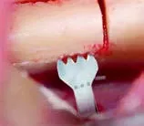 Набор насадок Satelec (Acteon) BS Kit (Bone Surgery - BS1S, BS2L, BS2R, BS4, BS5, BS6) для Piezotome CUBE/Solo (LED) 2/Piezotome 2/Implant Center 2 f87509 8