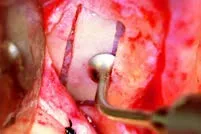 Набор насадок Satelec (Acteon) Sinus Lift Kit (SL1, SL2, SL3, SL4, SL5) для Piezotome CUBE/Solo (LED) 2/Piezotome 2/Implant Center 2 f87519 10