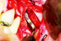 Набор насадок Satelec (Acteon) Sinus Lift Kit (SL1, SL2, SL3, SL4, SL5) для Piezotome CUBE/Solo (LED) 2/Piezotome 2/Implant Center 2 f87519 16