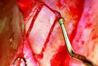 Набор насадок Satelec (Acteon) Sinus Lift Kit (SL1, SL2, SL3, SL4, SL5) для Piezotome CUBE/Solo (LED) 2/Piezotome 2/Implant Center 2 f87519 8