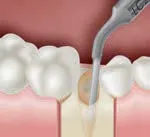 Набор насадок Satelec (Acteon) Essential Кit (BS1S, BS4, LC2, SL1, SL2, SL3) для Piezotome CUBE/Solo (LED) 2/Piezotome 2/Implant Center 2 f87528 11