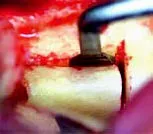 Набор насадок Satelec (Acteon) Essential Кit (BS1S, BS4, LC2, SL1, SL2, SL3) для Piezotome CUBE/Solo (LED) 2/Piezotome 2/Implant Center 2 f87528 5