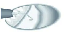 Набор насадок Satelec (Acteon) Essential Кit (BS1S, BS4, LC2, SL1, SL2, SL3) для Piezotome CUBE/Solo (LED) 2/Piezotome 2/Implant Center 2 f87528 7