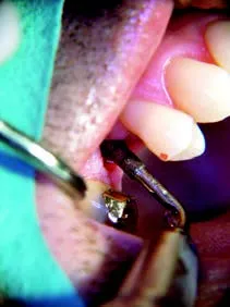 Насадка TKW4 для Satelec (Acteon) Piezotome CUBE/Solo (LED) 2/Piezotome 2/Implant Center 2 f87534 f87644 3