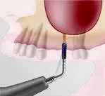 Насадка TKW4 для Satelec (Acteon) Piezotome CUBE/Solo (LED) 2/Piezotome 2/Implant Center 2 f87534 f87644 4