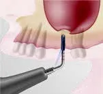 Набор насадок Satelec (Acteon) IntraLift Kit (TKW1, TKW2, TKW3, TKW4, TKW5) для Piezotome CUBE/Solo (LED) 2/Piezotome 2/Implant Center 2 f87536 10