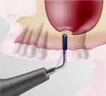 Набор насадок Satelec (Acteon) IntraLift Kit (TKW1, TKW2, TKW3, TKW4, TKW5) для Piezotome CUBE/Solo (LED) 2/Piezotome 2/Implant Center 2 f87536 15