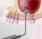 Набор насадок Satelec (Acteon) IntraLift Kit (TKW1, TKW2, TKW3, TKW4, TKW5) для Piezotome CUBE/Solo (LED) 2/Piezotome 2/Implant Center 2 f87536 17