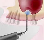 Набор насадок Satelec (Acteon) IntraLift Kit (TKW1, TKW2, TKW3, TKW4, TKW5) для Piezotome CUBE/Solo (LED) 2/Piezotome 2/Implant Center 2 f87536 18