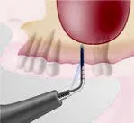 Набор насадок Satelec (Acteon) IntraLift Kit (TKW1, TKW2, TKW3, TKW4, TKW5) для Piezotome CUBE/Solo (LED) 2/Piezotome 2/Implant Center 2 f87536 4
