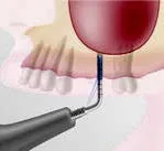 Набор насадок Satelec (Acteon) IntraLift Kit (TKW1, TKW2, TKW3, TKW4, TKW5) для Piezotome CUBE/Solo (LED) 2/Piezotome 2/Implant Center 2 f87536 7