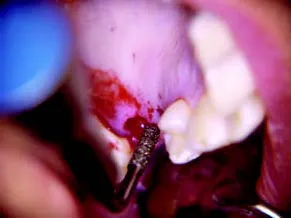 Набор насадок Satelec (Acteon) IntraLift Kit (TKW1, TKW2, TKW3, TKW4, TKW5) для Piezotome CUBE/Solo (LED) 2/Piezotome 2/Implant Center 2 f87536 8