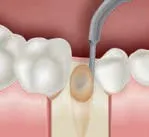 Набор насадок Satelec (Acteon) Extraction Kit (LC1, LC1-90°, LC2, LC2L, LC2R, Ninja™) для Piezotome CUBE/Solo (LED) 2/Piezotome 2/Implant Center 2 f87546 13