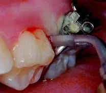 Набор насадок Satelec (Acteon) Extraction Kit (LC1, LC1-90°, LC2, LC2L, LC2R, Ninja™) для Piezotome CUBE/Solo (LED) 2/Piezotome 2/Implant Center 2 f87546 14
