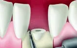 Насадка CE3 для Satelec (Acteon) Piezotome CUBE/Solo (LED) 2/Piezotome 2/Implant Center 2 f87553 f87653 4