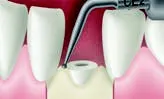 Набор насадок Satelec (Acteon) Crown Extension (BS6, CE1, CE2, CE3) для Piezotome CUBE/Solo (LED) 2/Piezotome 2/Implant Center 2 f87554 11