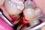 Набор насадок Satelec (Acteon) Crown Extension (BS6, CE1, CE2, CE3) для Piezotome CUBE/Solo (LED) 2/Piezotome 2/Implant Center 2 f87554 12