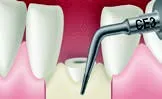 Набор насадок Satelec (Acteon) Crown Extension (BS6, CE1, CE2, CE3) для Piezotome CUBE/Solo (LED) 2/Piezotome 2/Implant Center 2 f87554 14