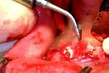 Набор насадок Satelec (Acteon) Crown Extension (BS6, CE1, CE2, CE3) для Piezotome CUBE/Solo (LED) 2/Piezotome 2/Implant Center 2 f87554 5