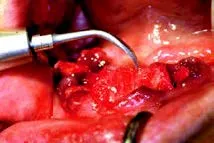 Набор насадок Satelec (Acteon) Crown Extension (BS6, CE1, CE2, CE3) для Piezotome CUBE/Solo (LED) 2/Piezotome 2/Implant Center 2 f87554 6