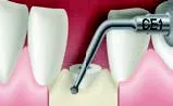 Набор насадок Satelec (Acteon) Crown Extension (BS6, CE1, CE2, CE3) для Piezotome CUBE/Solo (LED) 2/Piezotome 2/Implant Center 2 f87554 8