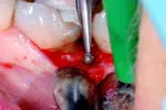 Набор насадок Satelec (Acteon) Crown Extension (BS6, CE1, CE2, CE3) для Piezotome CUBE/Solo (LED) 2/Piezotome 2/Implant Center 2 f87554 9
