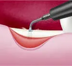 Насадка CS1 для Satelec (Acteon) Piezotome CUBE/Solo (LED) 2/Piezotome 2/Implant Center 2 f87561 f87629 3