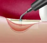 Насадка CS5 для Satelec (Acteon) Piezotome CUBE/Solo (LED) 2/Piezotome 2/Implant Center 2 f87565 f87633 3