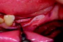 Набор насадок Satelec (Acteon) CS Кit (Crest Splitting - CS1, CS2, CS3, CS4, CS5, CS6) для Piezotome CUBE/Solo (LED) 2/Piezotome 2/Implant Center 2 f87567 11