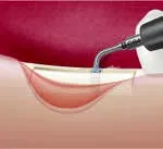 Набор насадок Satelec (Acteon) CS Кit (Crest Splitting - CS1, CS2, CS3, CS4, CS5, CS6) для Piezotome CUBE/Solo (LED) 2/Piezotome 2/Implant Center 2 f87567 13