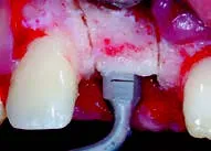 Набор насадок Satelec (Acteon) CS Кit (Crest Splitting - CS1, CS2, CS3, CS4, CS5, CS6) для Piezotome CUBE/Solo (LED) 2/Piezotome 2/Implant Center 2 f87567 14