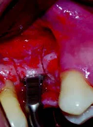 Набор насадок Satelec (Acteon) CS Кit (Crest Splitting - CS1, CS2, CS3, CS4, CS5, CS6) для Piezotome CUBE/Solo (LED) 2/Piezotome 2/Implant Center 2 f87567 17