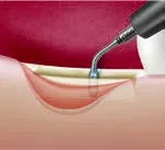 Набор насадок Satelec (Acteon) CS Кit (Crest Splitting - CS1, CS2, CS3, CS4, CS5, CS6) для Piezotome CUBE/Solo (LED) 2/Piezotome 2/Implant Center 2 f87567 19