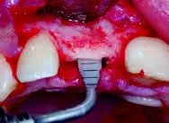 Набор насадок Satelec (Acteon) CS Кit (Crest Splitting - CS1, CS2, CS3, CS4, CS5, CS6) для Piezotome CUBE/Solo (LED) 2/Piezotome 2/Implant Center 2 f87567 5