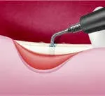 Набор насадок Satelec (Acteon) CS Кit (Crest Splitting - CS1, CS2, CS3, CS4, CS5, CS6) для Piezotome CUBE/Solo (LED) 2/Piezotome 2/Implant Center 2 f87567 7