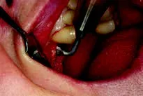 Набор насадок Satelec (Acteon) CS Кit (Crest Splitting - CS1, CS2, CS3, CS4, CS5, CS6) для Piezotome CUBE/Solo (LED) 2/Piezotome 2/Implant Center 2 f87567 8